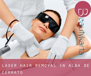Laser Hair removal in Alba de Cerrato