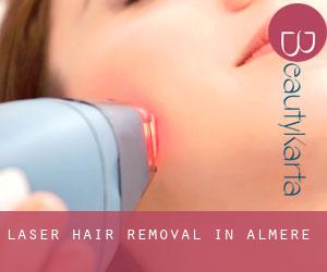 Laser Hair removal in Almere