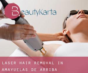 Laser Hair removal in Amayuelas de Arriba