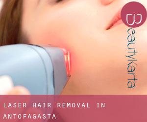 Laser Hair removal in Antofagasta