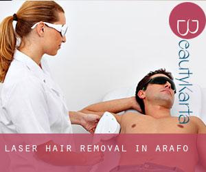 Laser Hair removal in Arafo