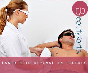 Laser Hair removal in Caceres