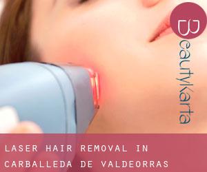 Laser Hair removal in Carballeda de Valdeorras