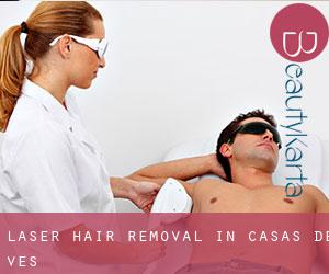 Laser Hair removal in Casas de Ves