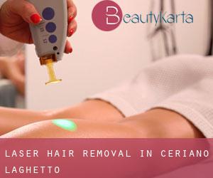Laser Hair removal in Ceriano Laghetto