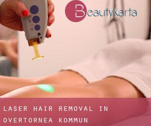 Laser Hair removal in Övertorneå Kommun