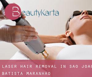 Laser Hair removal in São João Batista (Maranhão)