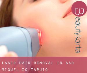 Laser Hair removal in São Miguel do Tapuio