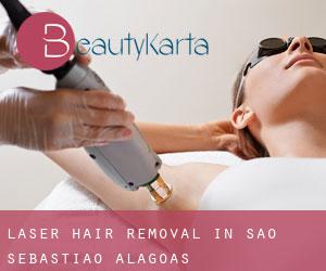 Laser Hair removal in São Sebastião (Alagoas)