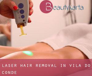 Laser Hair removal in Vila do Conde