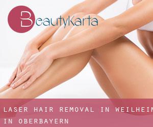 Laser Hair removal in Weilheim in Oberbayern